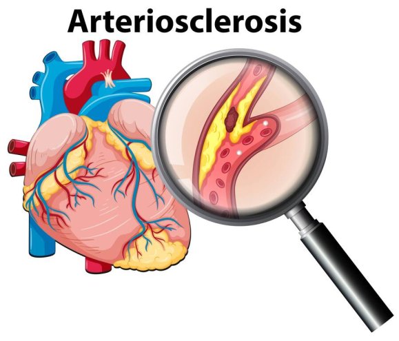 What is Arteriosclerosis and How Do I Prevent It?