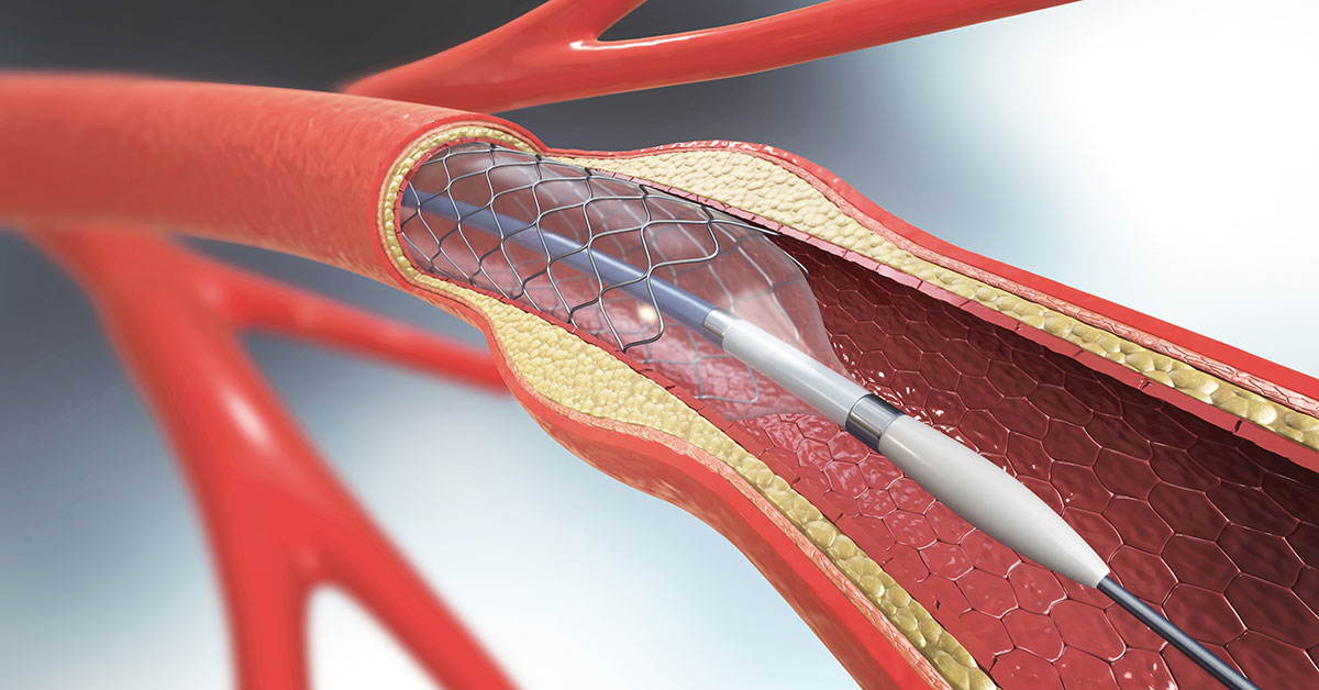 Carotid Artery Stenting